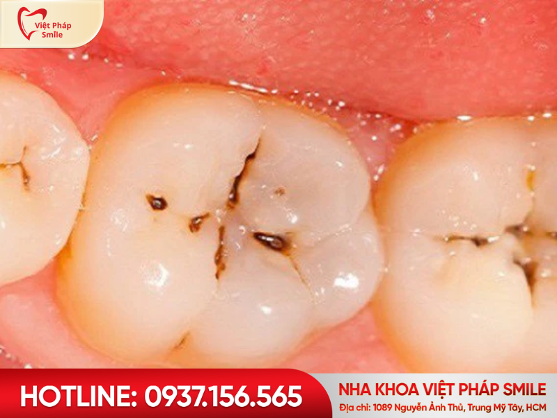 Sâu răng là gì? Nguyên nhân, dấu hiệu và cách điều trị hiệu quả 2 Biểu hiện của sâu răng