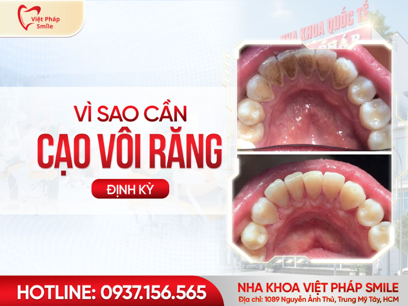Cao răng là gì và vì sao cần cạo vôi răng định kỳ