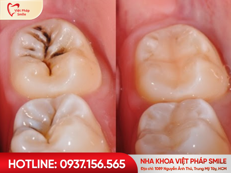 Khi nào nên trám răng