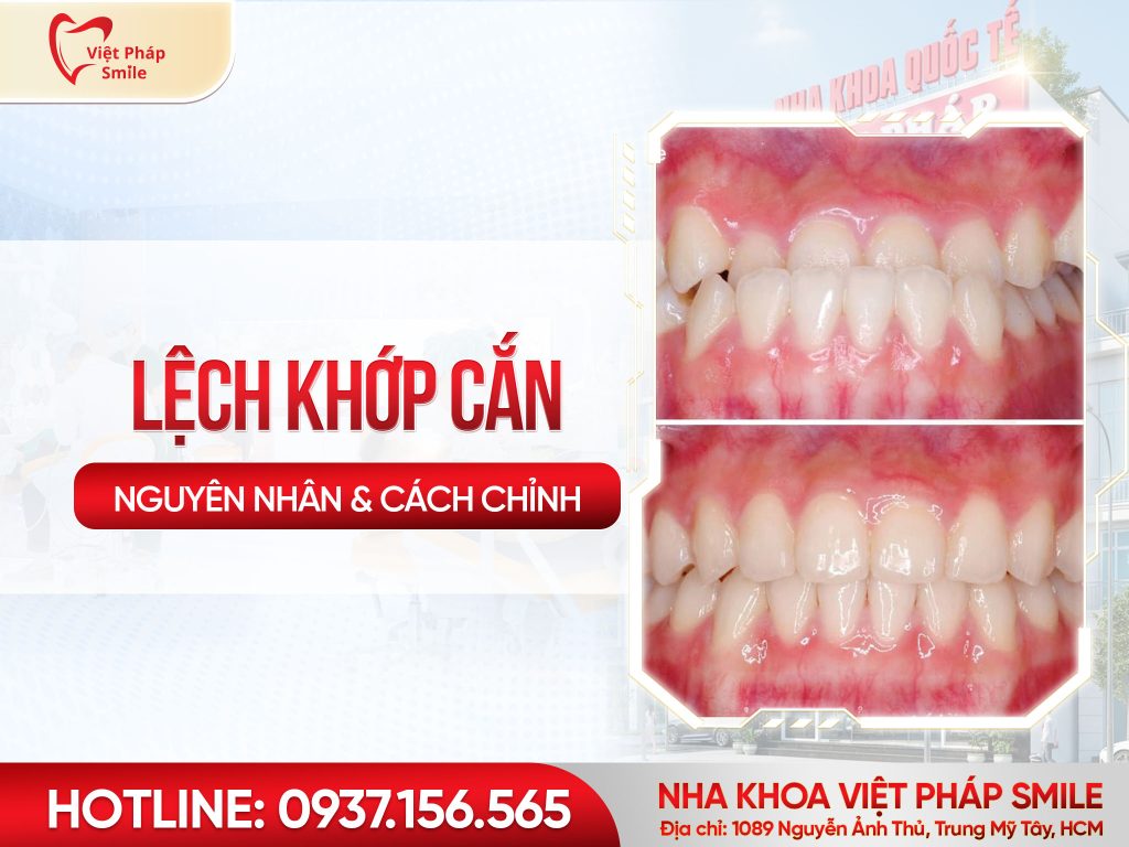 Lệch khớp cắn ảnh hưởng gì Cách khắc phục hiệu quả bằng chỉnh nha