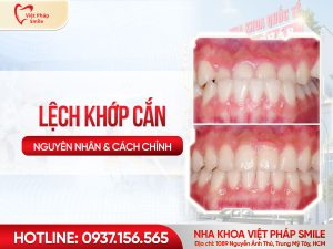 Lệch khớp cắn ảnh hưởng gì Cách khắc phục hiệu quả bằng chỉnh nha