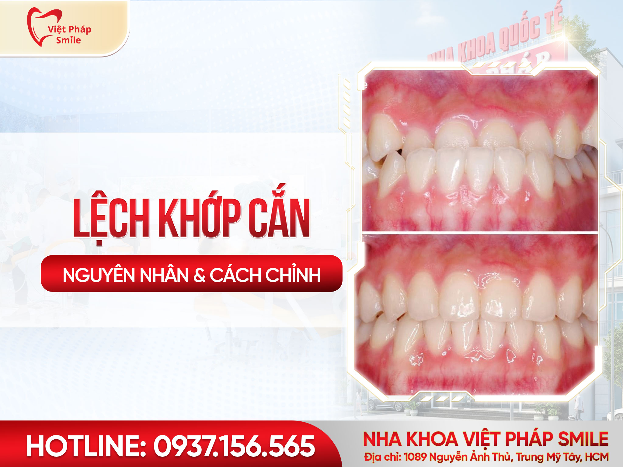 Lệch khớp cắn ảnh hưởng gì Cách khắc phục hiệu quả bằng chỉnh nha