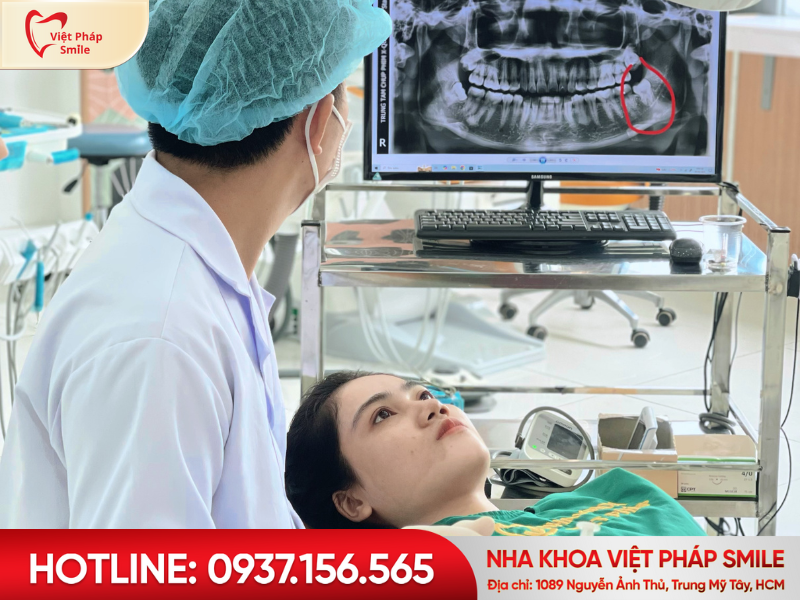 Quy trình nhổ răng khôn an toàn tại Nha khoa Việt Pháp Smile
