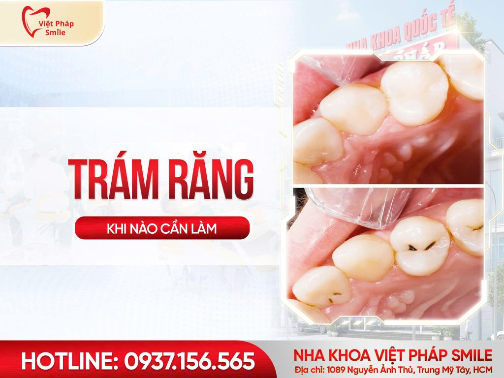 Trám răng là gì Khi nào nên trám răng và trám răng có bền không