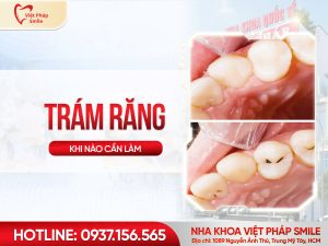 Trám răng là gì Khi nào nên trám răng và trám răng có bền không