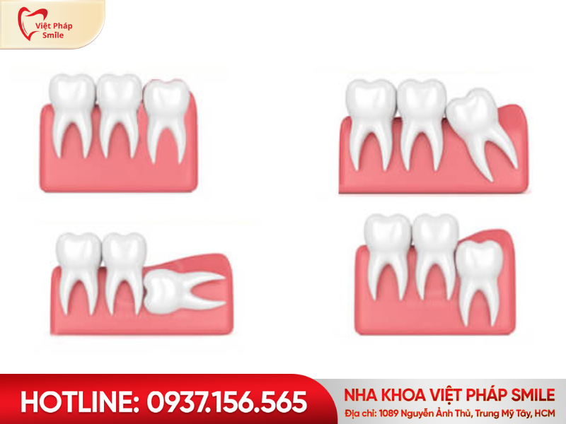 cac-dang-rang-khon-moc-lech