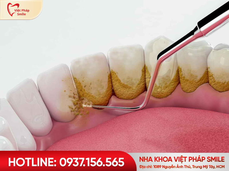 lay-cao-rang-dinh-ky