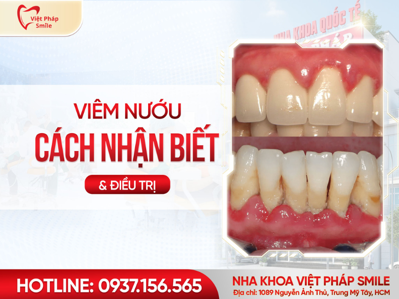 viem-nuou-rang-va-cach-dieu-tri