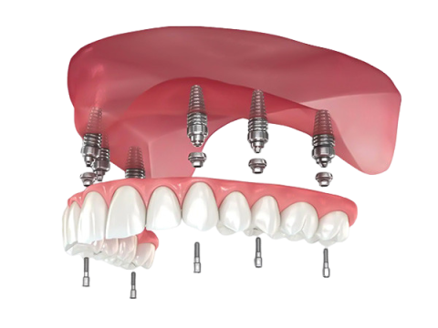img implant nguyen ham 1