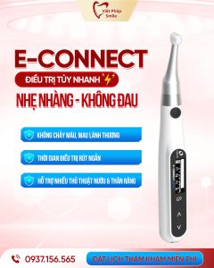 Nha khoa Quận 12 - Vì sao Nha Khoa Việt Pháp Smile được đánh giá cao tại Quận 12? 7 mau-dieu-tri-tuy-e-connect
