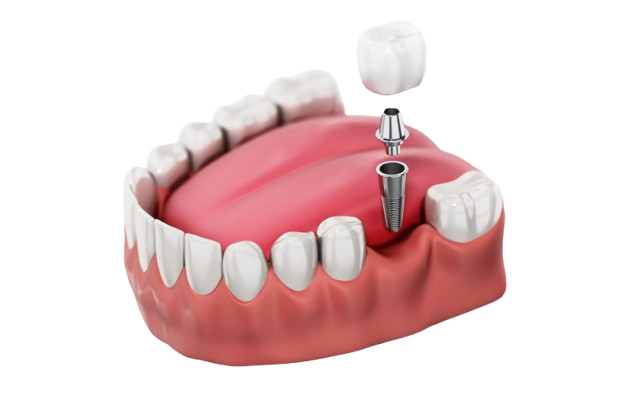 trong rang implant don le la gi removebg preview