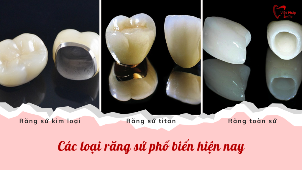 Bọc răng sứ phường Hạnh Thông – Răng sáng đẹp, bền chắc theo thời gian 2 Các loại răng sứ phổ biến hiện nay
