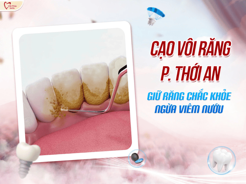 Cạo vôi răng phường Thới An – Giữ răng chắc khỏe, ngừa viêm nướu