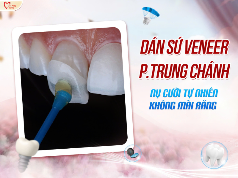 Dán sứ Veneer phường Trung Chánh – Nụ cười tự nhiên, không mài răng