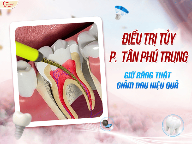 Điều trị tủy răng phường Tân Phú Trung – Giữ răng thật, giảm đau hiệu quả