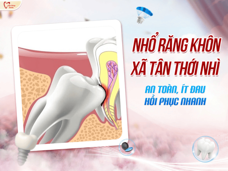 Nhổ răng khôn xã Tân Thới Nhì – An toàn, ít đau, hồi phục nhanh