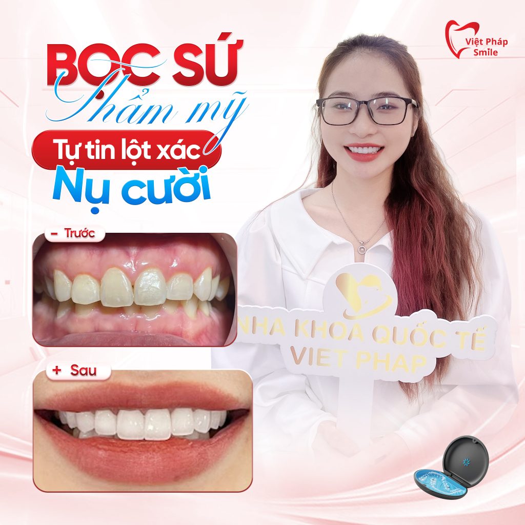 Bọc răng sứ phường Tây Thạnh – Giải pháp thẩm mỹ răng bền đẹp 1 boc-su-tham-my-11
