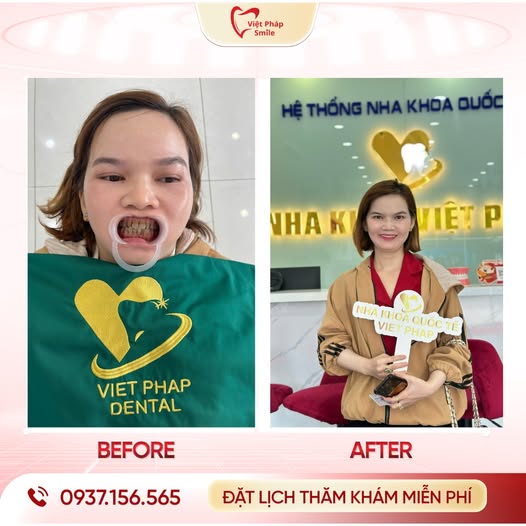 Bọc răng sứ phường Hạnh Thông – Răng sáng đẹp, bền chắc theo thời gian 4 boc-su-tham-my