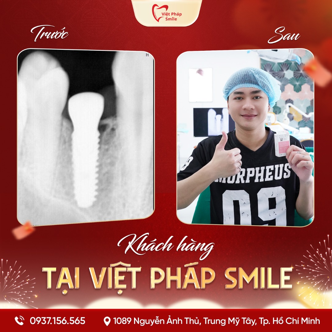 Thạc Sĩ – Bác Sĩ Văn Hồng Phượng 7 implant 2