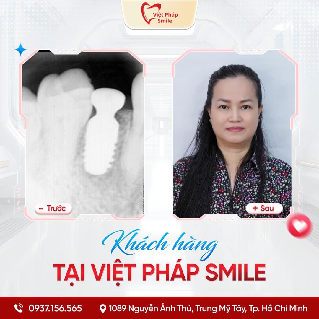 Trồng răng Implant phường Thạnh Mỹ Tây – Phục hình răng mất an toàn 3 implant 4
