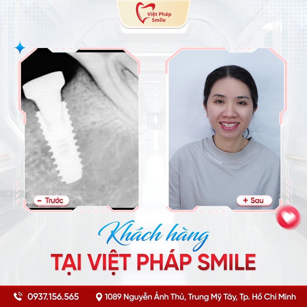 Trồng răng Implant phường Thạnh Mỹ Tây – Phục hình răng mất an toàn 4 implant 5