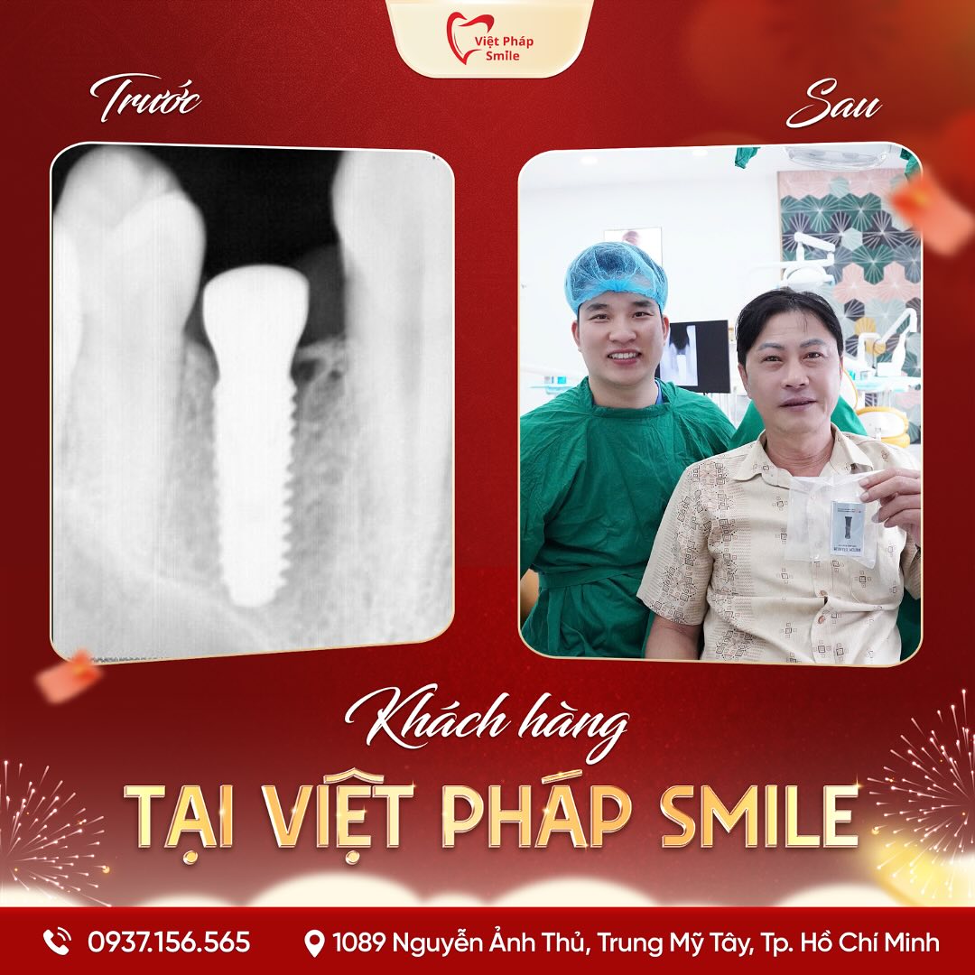 Thạc Sĩ – Bác Sĩ Văn Hồng Phượng 4 implant