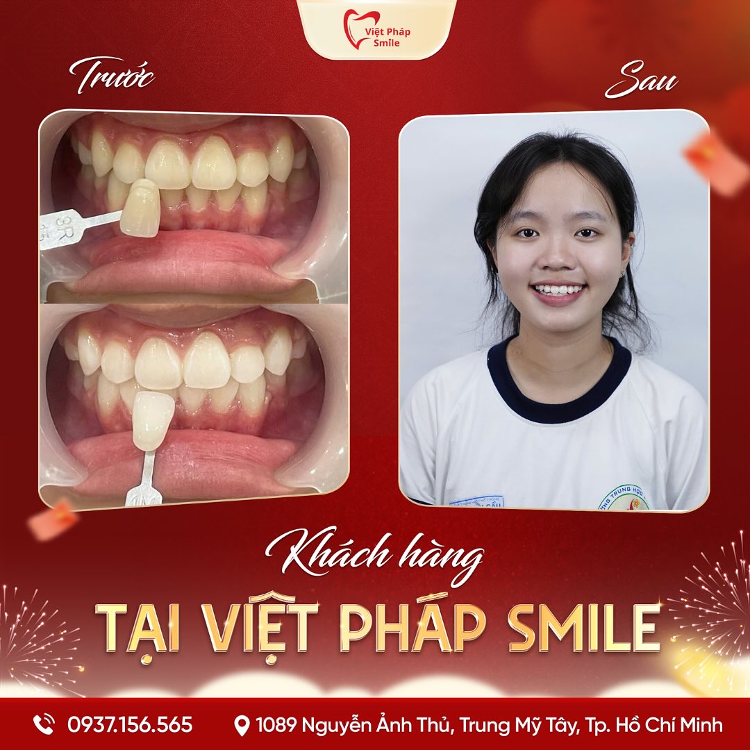 Tẩy trắng răng phường Tân Sơn Hòa – Cải thiện răng ố vàng hiệu quả 2 tay-trang-rang-nha-khoa-viet-phap-smile-quan-12