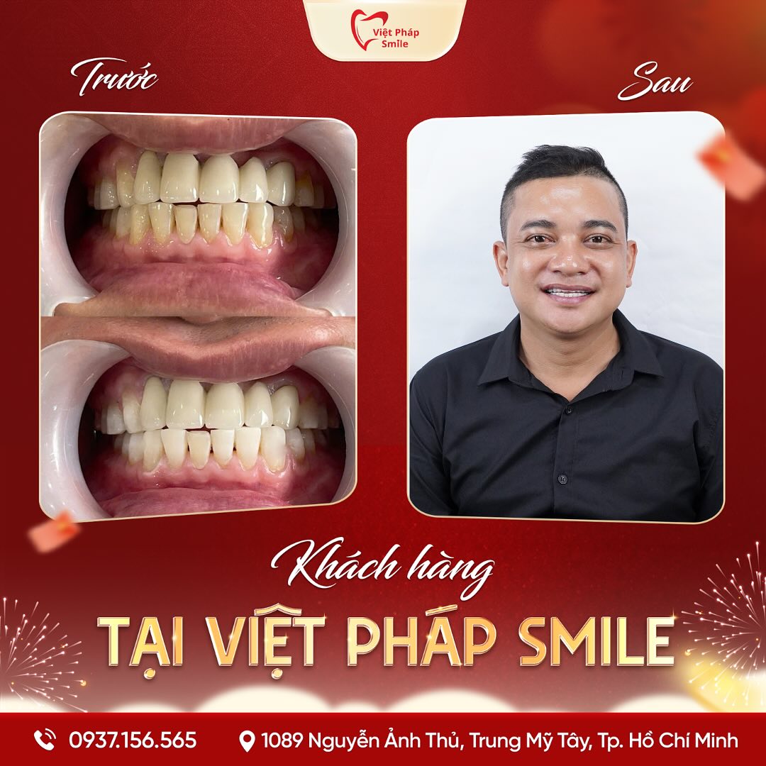 Tẩy trắng răng phường Tân Sơn Hòa – Cải thiện răng ố vàng hiệu quả 1 tay-trang-rang