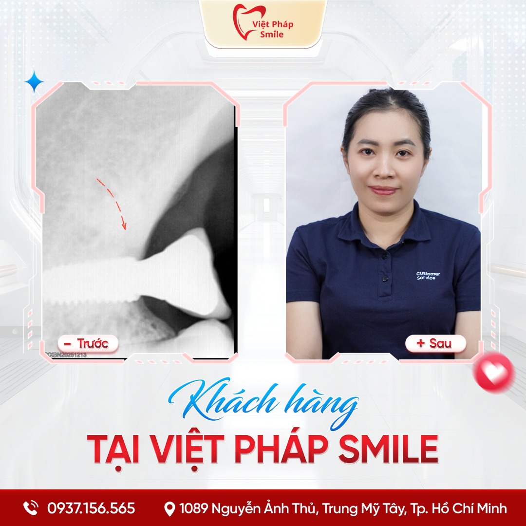 Trồng răng Implant phường Hóc Môn – Phục hồi răng mất, ăn nhai thoải mái 2 trong-rang-implant-nha-khoa-viet-phap-smile-1