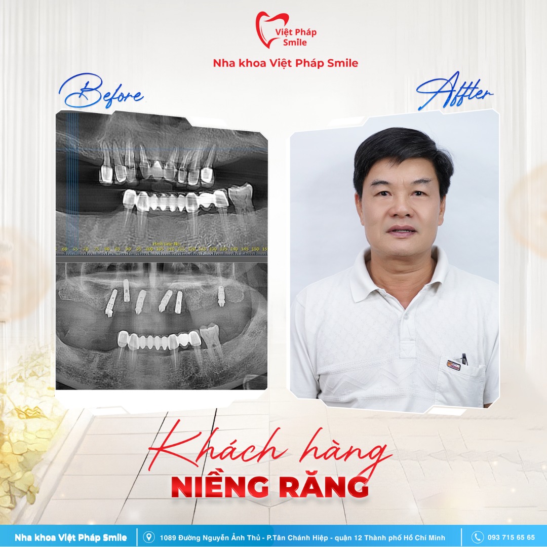 Trồng răng Implant phường Hóc Môn – Phục hồi răng mất, ăn nhai thoải mái 1 trong-rang-implant-nha-khoa-viet-phap-smile