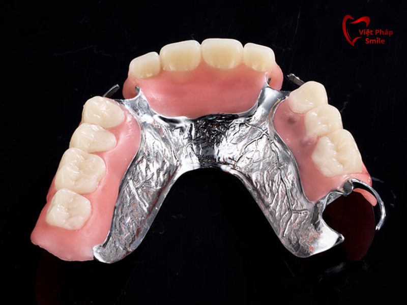 Phục hình tháo lắp xã Bà Điểm – Giải pháp tiết kiệm cho người mất răng 2 Hàm giả tháo lắp bán phần