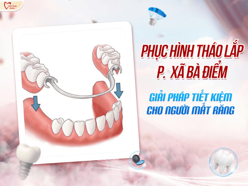 Phục hình tháo lắp xã Bà Điểm – Giải pháp tiết kiệm cho người mất răng 1 Phục hình tháo lắp xã Bà Điểm – Giải pháp tiết kiệm cho người mất răng