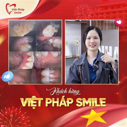 Đính đá răng 8 dieu-tri-nha-chu-1