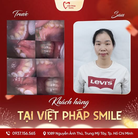 Đính đá răng 7 dieu-tri-nha-chu-2