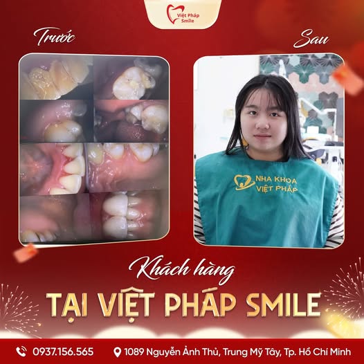 Đính đá răng 9 dieu-tri-nha-chu-3