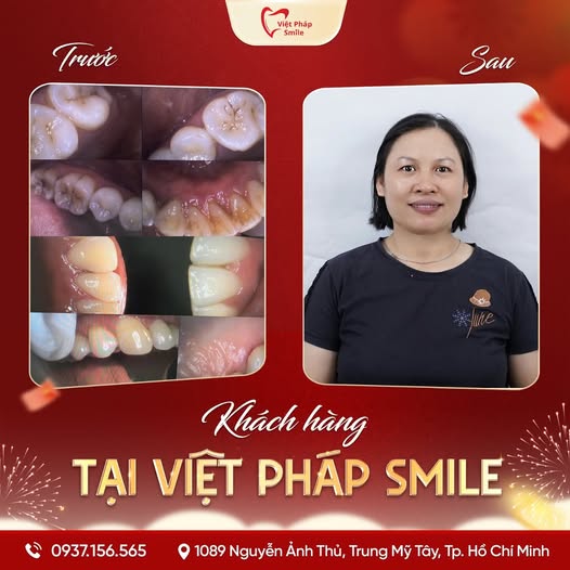 Đính đá răng 10 dieu-tri-nha-chu-5