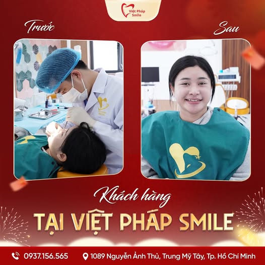 Dán Veneer 21 dinh-da-1