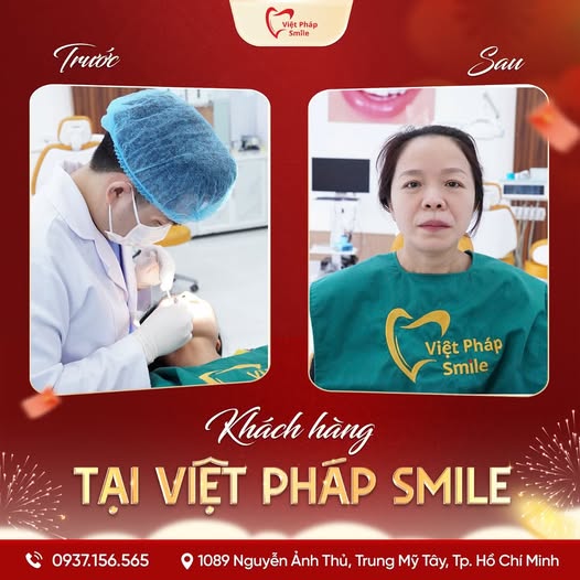 Dán Veneer 22 nho-rang-kh-1