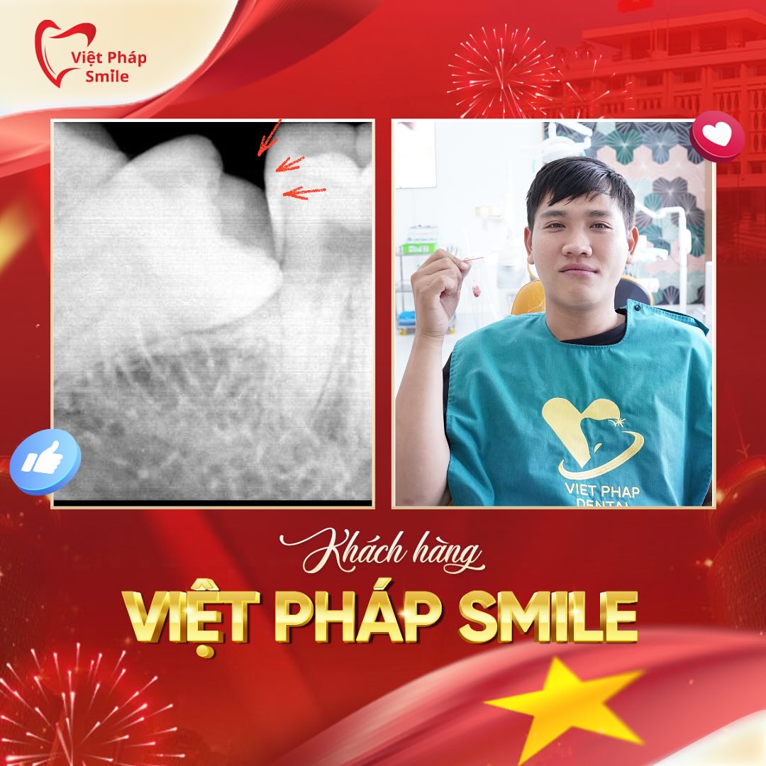 Nhổ răng khôn 13 nho-rang-khon-1