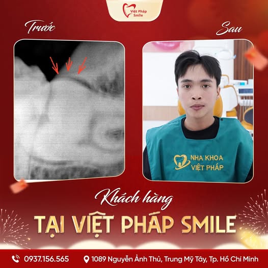 Nhổ răng khôn 12 nho-rang-khon-2