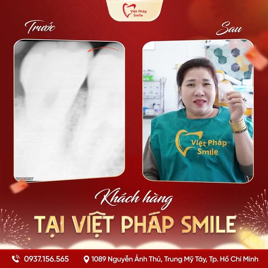 Nhổ răng khôn 11 nho-rang-khon-3