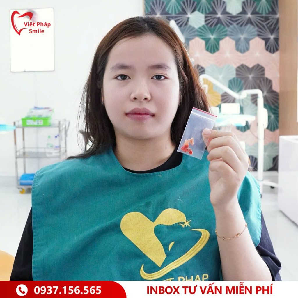 Nha khoa quận 12 uy tín – Việt Pháp Smile | Implant, Niềng răng, Răng sứ 20 nho-rang-khon-5