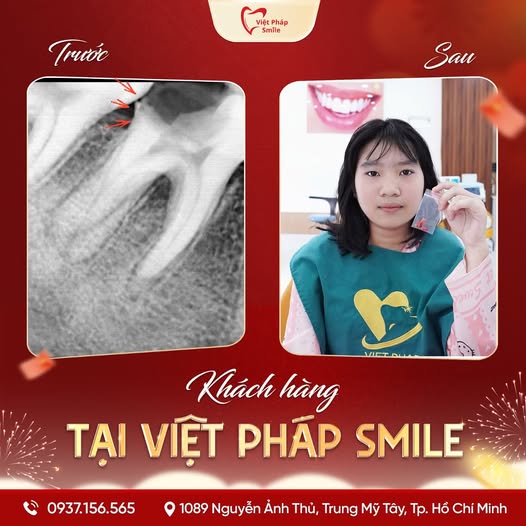 Nhổ răng thường, răng sữa 6 nho-rang-sua-1