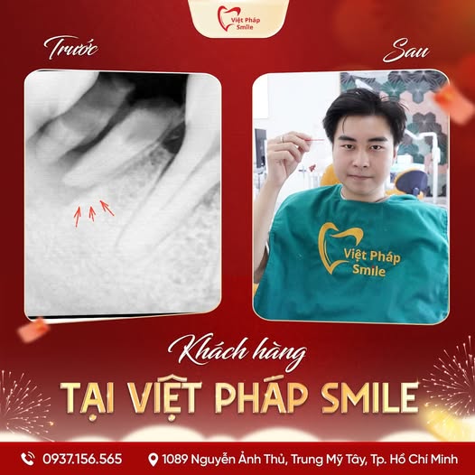 Nhổ răng thường, răng sữa 8 nho-rang-thuong-kh-3