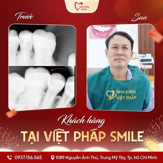 Nhổ răng thường, răng sữa 7 nho-rang-thuong-kh-5