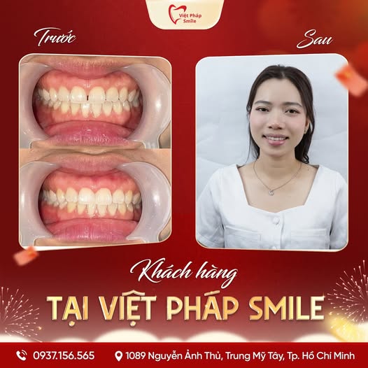 Dán Veneer 20 tram-rang-tham-my-kh-1