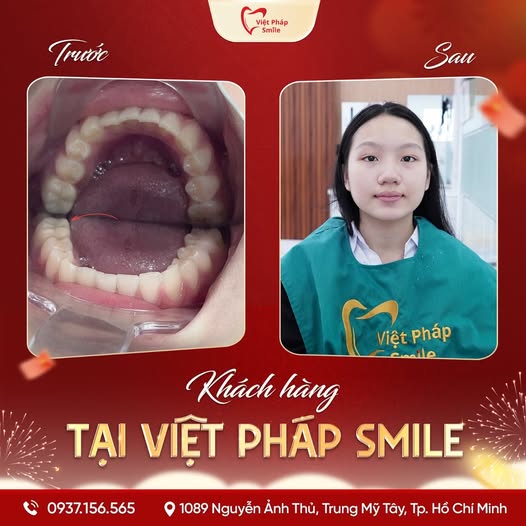 Trám răng thẩm mỹ 13 tram-rang-tham-my-kh-2