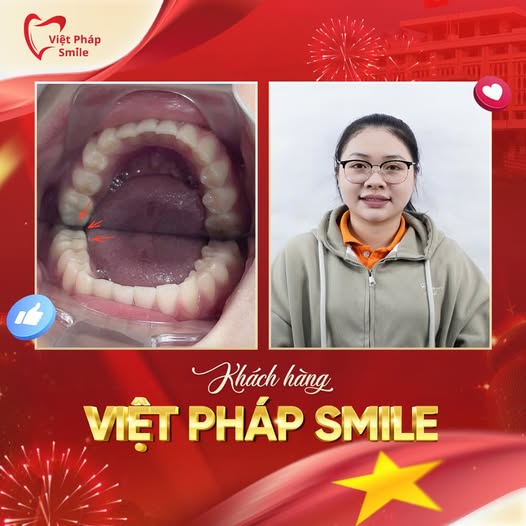 Trám răng thẩm mỹ 12 tram-rang-tham-my-kh-3