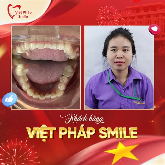 Trám răng thẩm mỹ 11 tram-rang-tham-my-kh-5