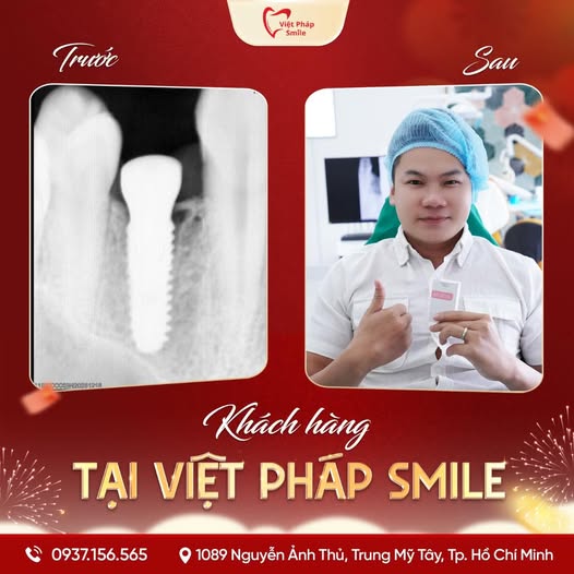 5 sai lầm khi trồng Implant và cách Việt Pháp Smile khắc phục triệt để 3 trồng implant uy tin